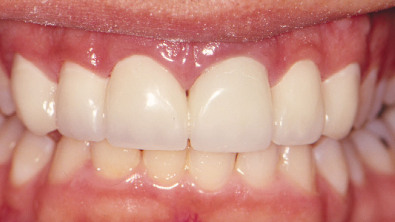 Temporary Crowns & Bridges Resin